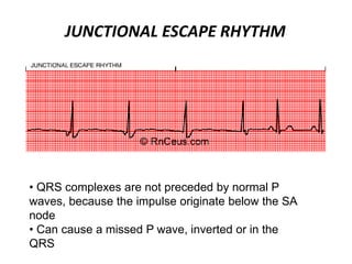 JUNCTIONAL ESCAPE RHYTHM
• QRS complexes are not preceded by normal P
waves, because the impulse originate below the SA
node
• Can cause a missed P wave, inverted or in the
QRS
 