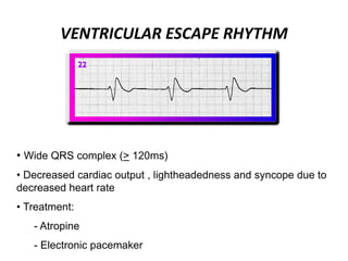 VENTRICULAR ESCAPE RHYTHM
• Wide QRS complex (> 120ms)
• Decreased cardiac output , lightheadedness and syncope due to
decreased heart rate
• Treatment:
- Atropine
- Electronic pacemaker
 
