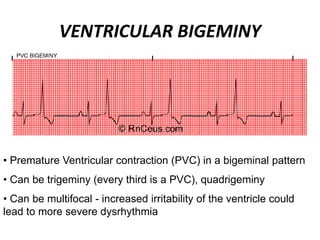 VENTRICULAR BIGEMINY
• Premature Ventricular contraction (PVC) in a bigeminal pattern
• Can be trigeminy (every third is a PVC), quadrigeminy
• Can be multifocal - increased irritability of the ventricle could
lead to more severe dysrhythmia
 