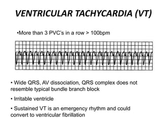 VENTRICULAR TACHYCARDIA (VT)
•More than 3 PVC’s in a row > 100bpm
• Wide QRS, AV dissociation, QRS complex does not
resemble typical bundle branch block
• Irritable ventricle
• Sustained VT is an emergency rhythm and could
convert to ventricular fibrillation
 