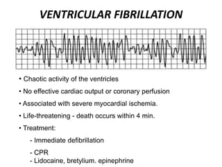 VENTRICULAR FIBRILLATION
• Chaotic activity of the ventricles
• No effective cardiac output or coronary perfusion
• Associated with severe myocardial ischemia.
• Life-threatening - death occurs within 4 min.
• Treatment:
- Immediate defibrillation
- CPR
- Lidocaine, bretylium. epinephrine
 