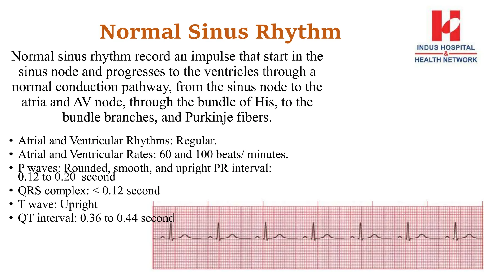 Normal Sinus Rhythm
Normal sinus rhythm record an impulse that start in the
sinus node and progresses to the ventricles through a
normal conduction pathway, from the sinus node to the
atria and AV node, through the bundle of His, to the
bundle branches, and Purkinje fibers.
• Atrial and Ventricular Rhythms: Regular.
• Atrial and Ventricular Rates: 60 and 100 beats/ minutes.
• P waves: Rounded, smooth, and upright PR interval:
0.12 to 0.20 second
• QRS complex: < 0.12 second
• T wave: Upright
• QT interval: 0.36 to 0.44 second
 