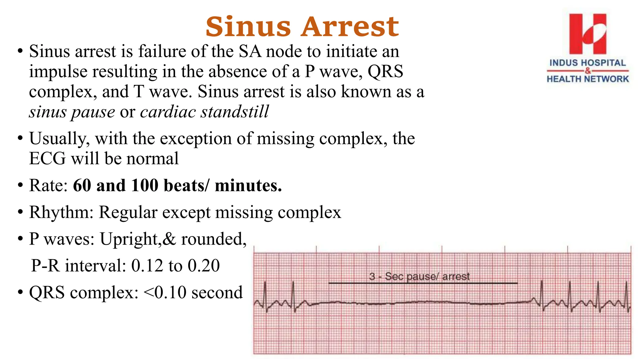 Sinus Arrest
• Sinus arrest is failure of the SA node to initiate an
impulse resulting in the absence of a P wave, QRS
complex, and T wave. Sinus arrest is also known as a
sinus pause or cardiac standstill
• Usually, with the exception of missing complex, the
ECG will be normal
• Rate: 60 and 100 beats/ minutes.
• Rhythm: Regular except missing complex
• P waves: Upright,& rounded,
P-R interval: 0.12 to 0.20
• QRS complex: <0.10 second
 