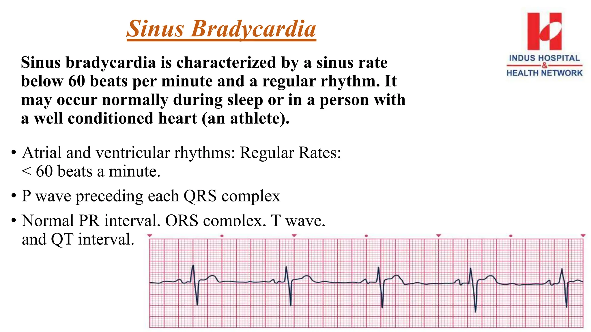 Sinus Bradycardia
Sinus bradycardia is characterized by a sinus rate
below 60 beats per minute and a regular rhythm. It
may occur normally during sleep or in a person with
a well conditioned heart (an athlete).
• Atrial and ventricular rhythms: Regular Rates:
< 60 beats a minute.
• P wave preceding each QRS complex
• Normal PR interval, QRS complex, T wave,
and QT interval.
 