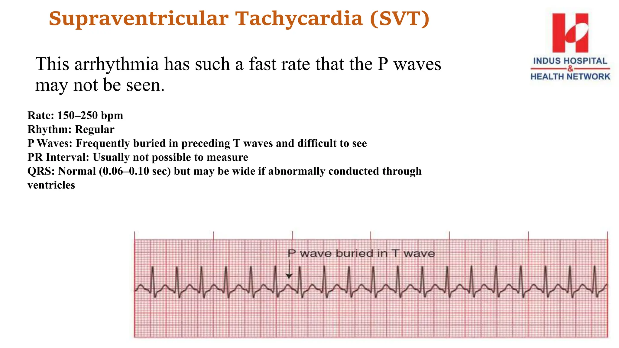 Supraventricular Tachycardia (SVT)
This arrhythmia has such a fast rate that the P waves
may not be seen.
Rate: 150–250 bpm
Rhythm: Regular
P Waves: Frequently buried in preceding T waves and difficult to see
PR Interval: Usually not possible to measure
QRS: Normal (0.06–0.10 sec) but may be wide if abnormally conducted through
ventricles
 