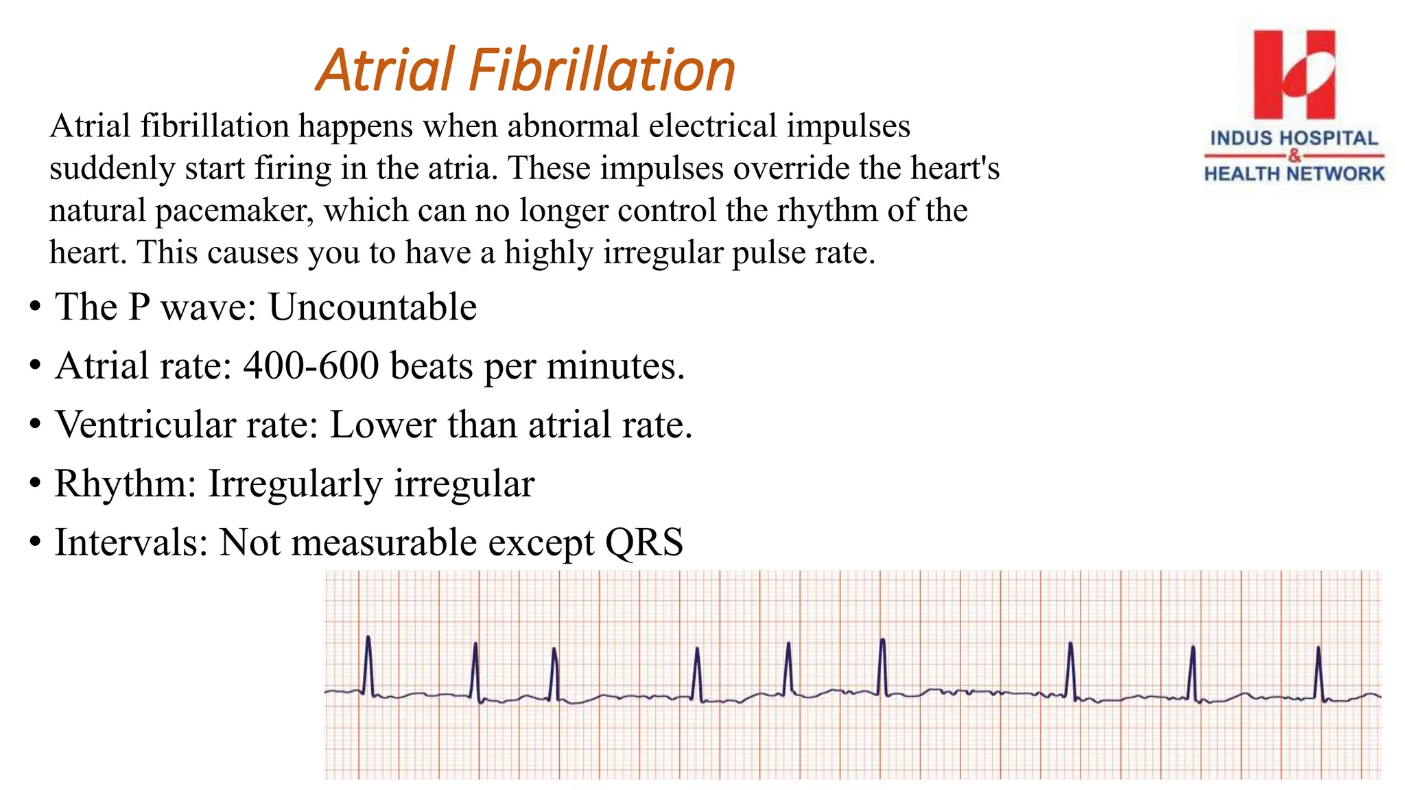 Atrial fibrillation happens when abnormal electrical impulses
suddenly start firing in the atria. These impulses override the heart's
natural pacemaker, which can no longer control the rhythm of the
heart. This causes you to have a highly irregular pulse rate.
Atrial Fibrillation
• The P wave: Uncountable
• Atrial rate: 400-600 beats per minutes.
• Ventricular rate: Lower than atrial rate.
• Rhythm: Irregularly irregular
• Intervals: Not measurable except QRS
 