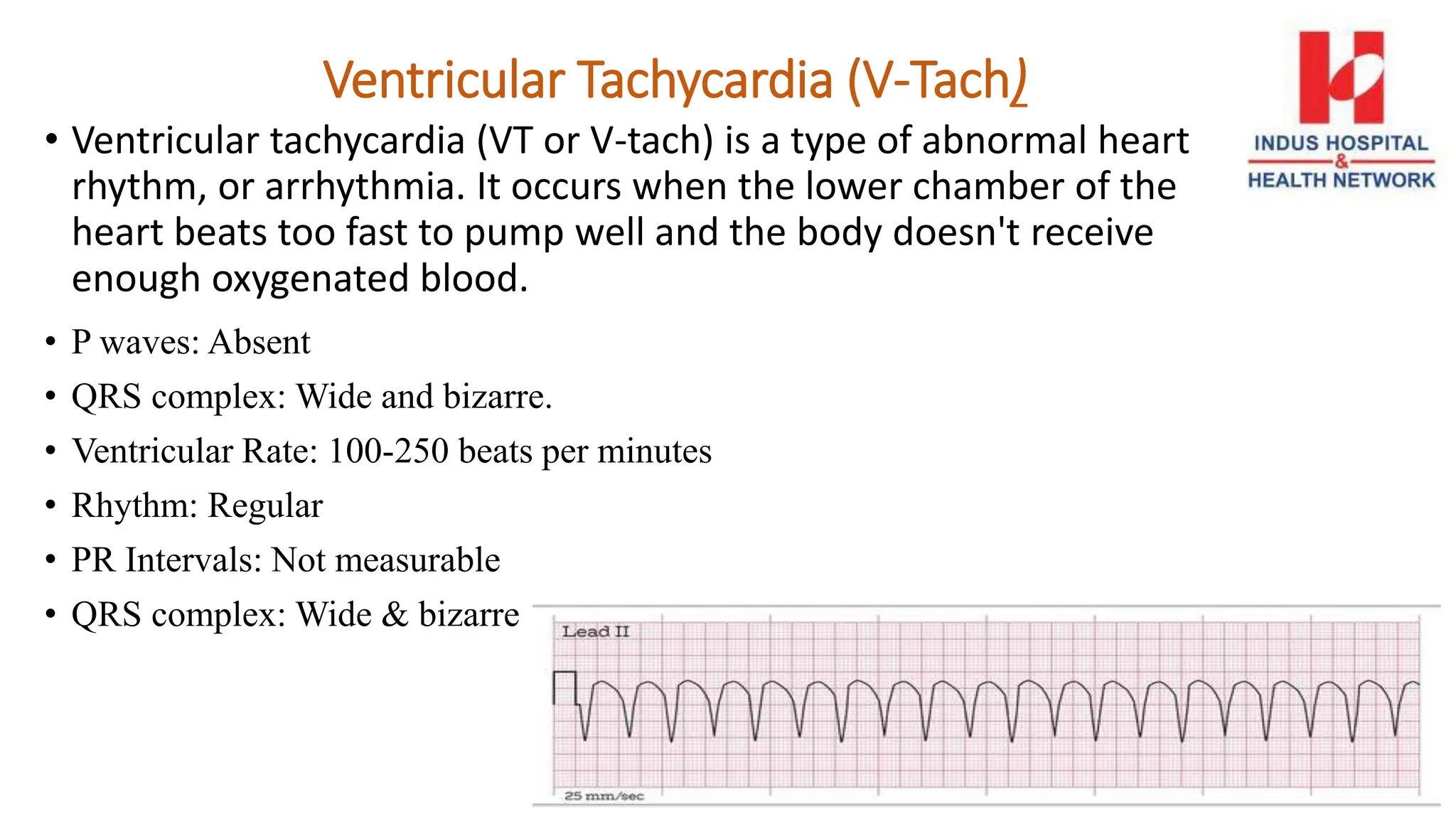 Ventricular Tachycardia (V-Tach)
• Ventricular tachycardia (VT or V-tach) is a type of abnormal heart
rhythm, or arrhythmia. It occurs when the lower chamber of the
heart beats too fast to pump well and the body doesn't receive
enough oxygenated blood.
• P waves: Absent
• QRS complex: Wide and bizarre.
• Ventricular Rate: 100-250 beats per minutes
• Rhythm: Regular
• PR Intervals: Not measurable
• QRS complex: Wide & bizarre
 