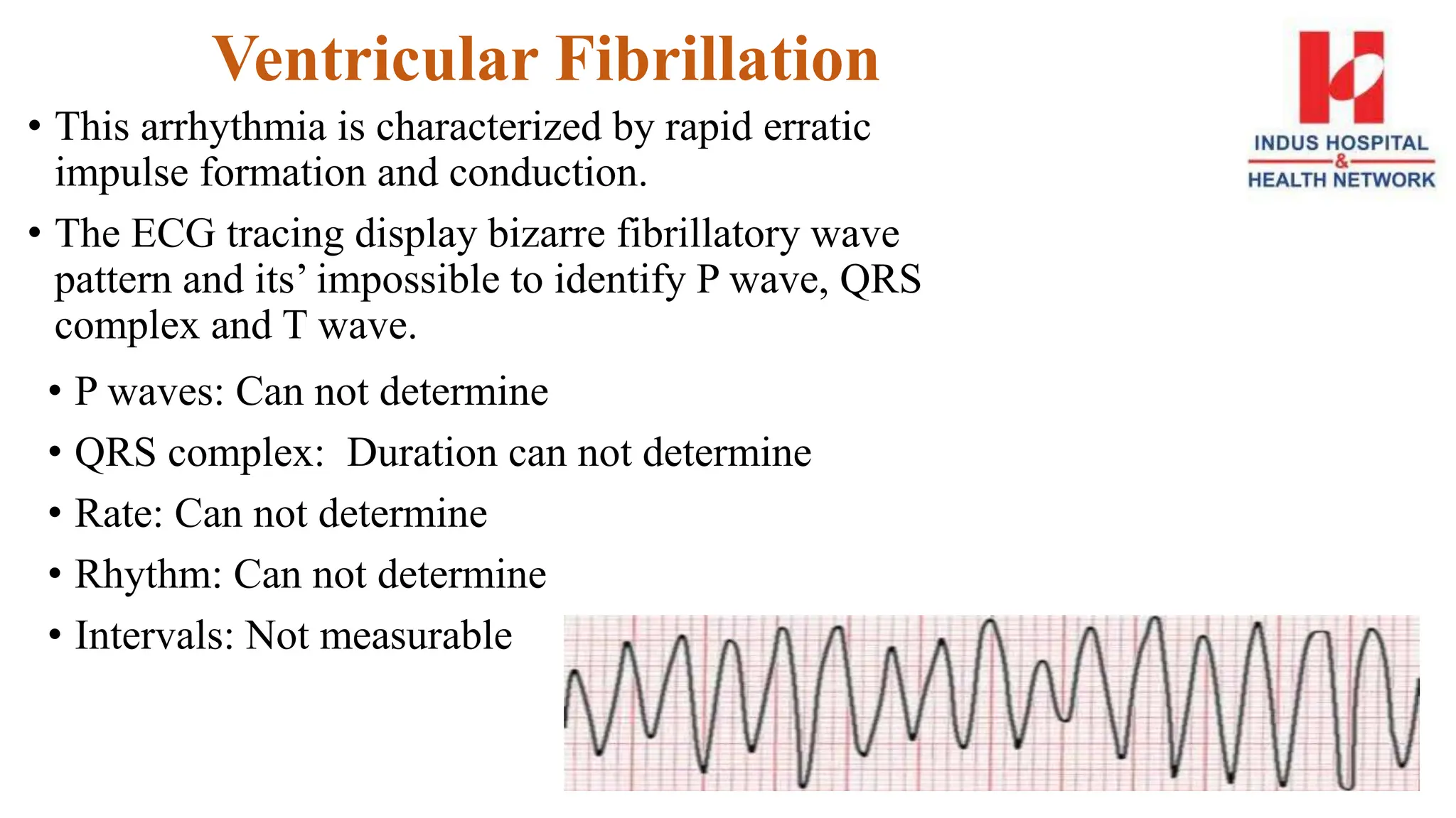 Ventricular Fibrillation
• This arrhythmia is characterized by rapid erratic
impulse formation and conduction.
• The ECG tracing display bizarre fibrillatory wave
pattern and its’ impossible to identify P wave, QRS
complex and T wave.
• P waves: Can not determine
• QRS complex: Duration can not determine
• Rate: Can not determine
• Rhythm: Can not determine
• Intervals: Not measurable
 
