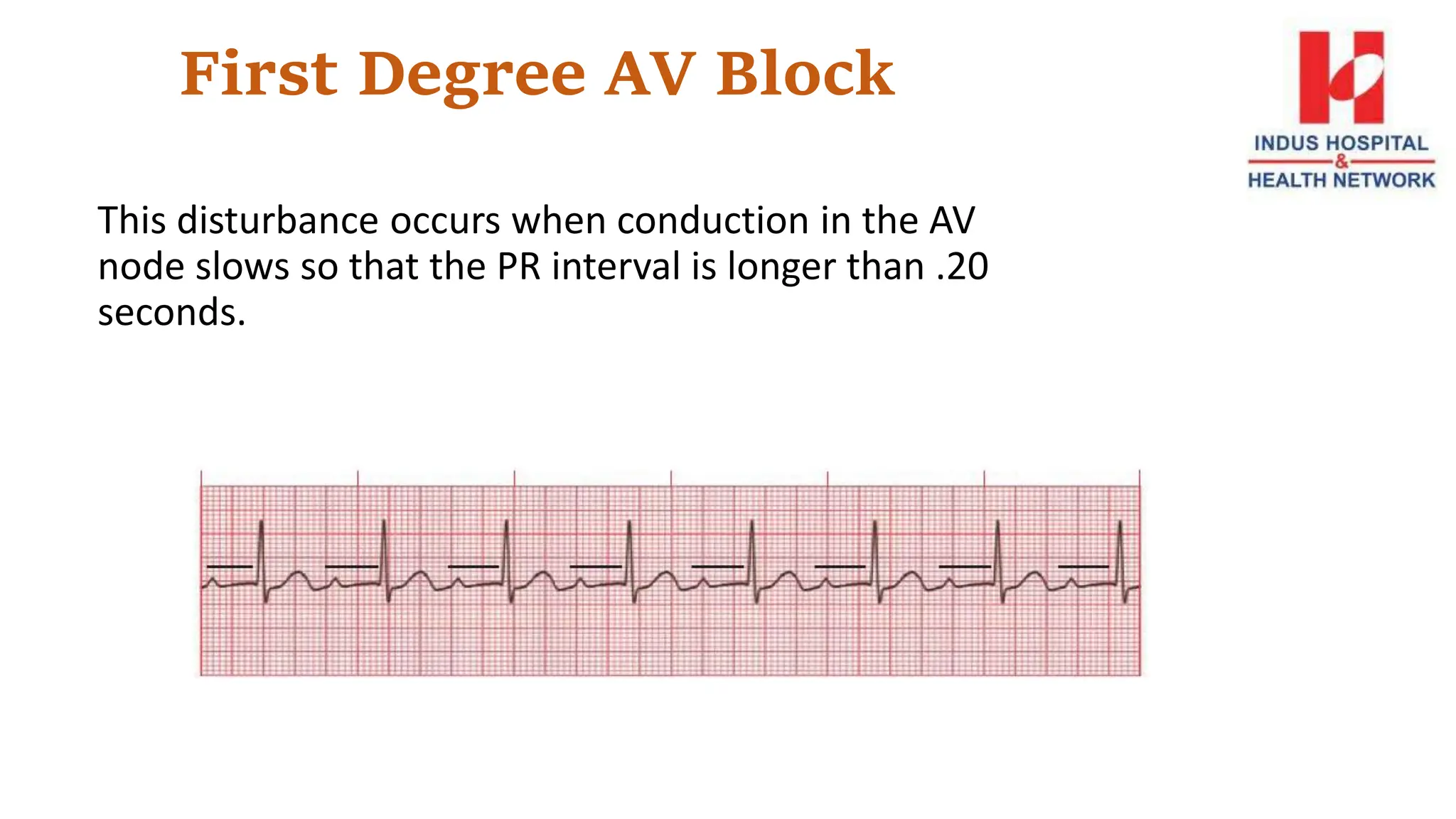 First Degree AV Block
This disturbance occurs when conduction in the AV
node slows so that the PR interval is longer than .20
seconds.
 