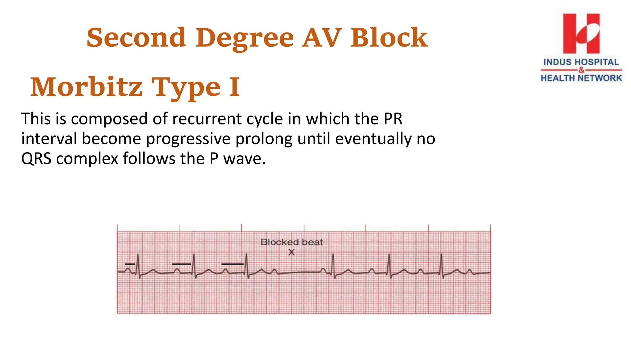 Second Degree AV Block
Morbitz Type I
This is composed of recurrent cycle in which the PR
interval become progressive prolong until eventually no
QRS complex follows the P wave.
 