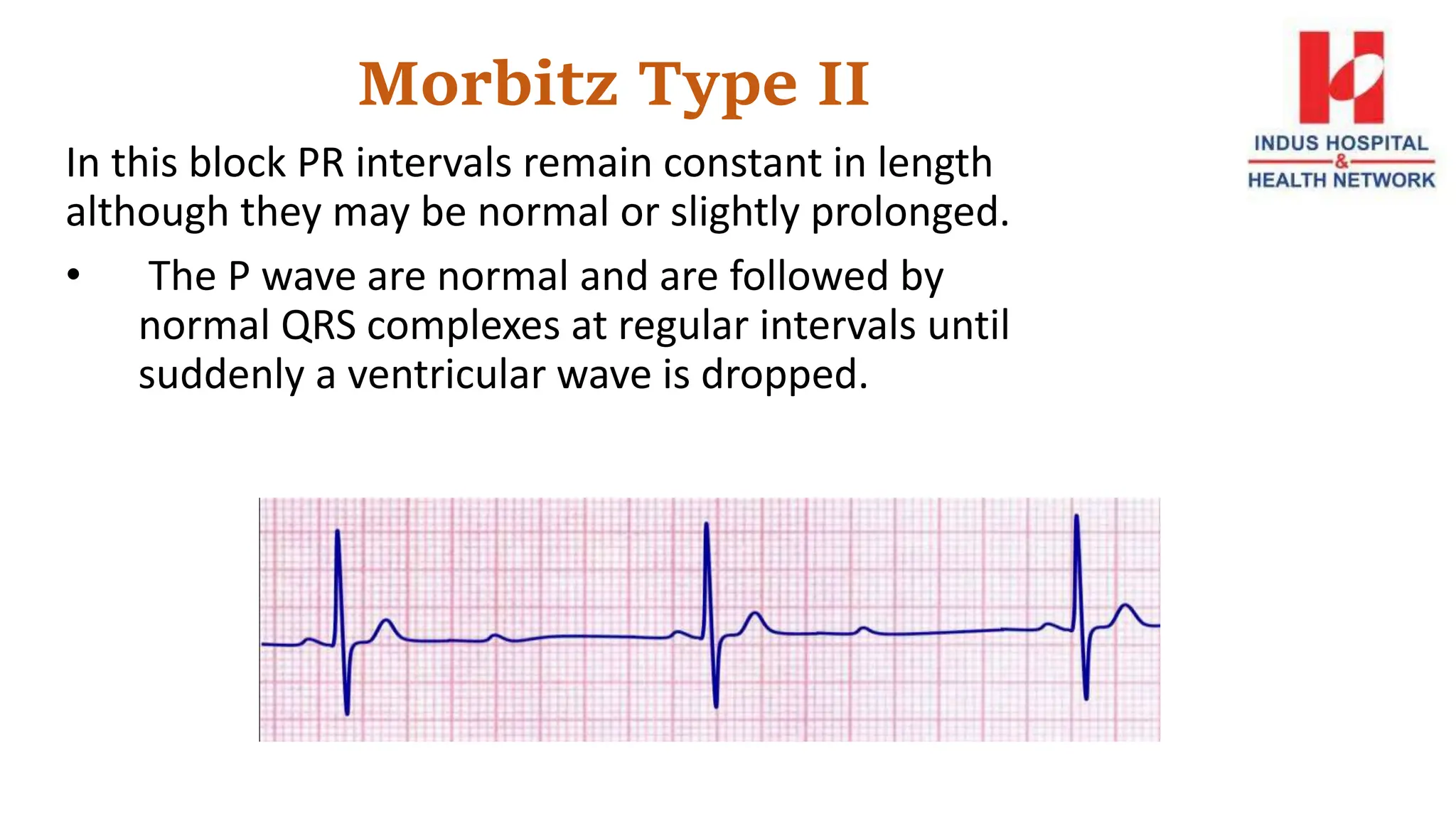 Morbitz Type II
In this block PR intervals remain constant in length
although they may be normal or slightly prolonged.
• The P wave are normal and are followed by
normal QRS complexes at regular intervals until
suddenly a ventricular wave is dropped.
 