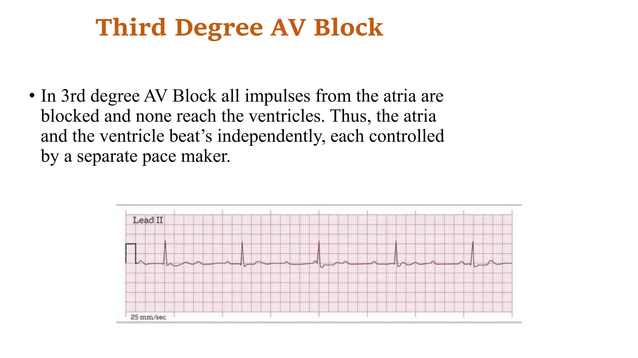 Third Degree AV Block
• In 3rd degree AV Block all impulses from the atria are
blocked and none reach the ventricles. Thus, the atria
and the ventricle beat’s independently, each controlled
by a separate pace maker.
 