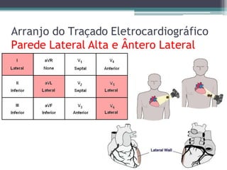 Arranjo do Traçado Eletrocardiográfico
Parede Lateral Alta e Ântero Lateral
 