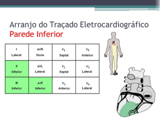 Arranjo do Traçado Eletrocardiográfico
Parede Inferior
 