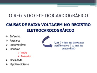 O REGISTRO ELETROCARDIOGRÁFICO
CAUSAS DE BAIXA VOLTAGEM NO REGISTRO
ELETROCARDIOGRÁFICO
 Enfisema
 Anasarca
 Pneumotórax
 Derrame
 Pleural
 Pericárdico
 Obesidade
 Hipotireoidismo
(QRS  5 mm nas derivações
periféricas ou  10 mm nas
precordiais)
 