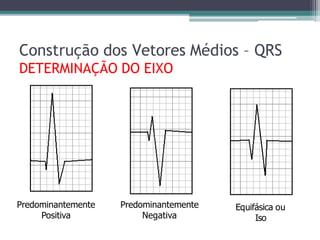 Construção dos Vetores Médios – QRS
DETERMINAÇÃO DO EIXO
Predominantemente
Positiva
Predominantemente
Negativa
Equifásica ou
Iso
 