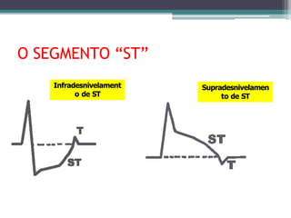 O SEGMENTO “ST”
Infradesnivelament
o de ST
Supradesnivelamen
to de ST
 