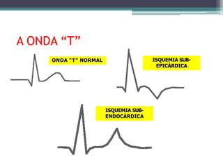 A ONDA “T”
ONDA “T” NORMAL ISQUEMIA SUB-
EPICÁRDICA
ISQUEMIA SUB-
ENDOCÁRDICA
 