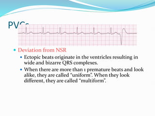 PVCs
 Deviation from NSR
 Ectopic beats originate in the ventricles resulting in
wide and bizarre QRS complexes.
 When there are more than 1 premature beats and look
alike, they are called “uniform”. When they look
different, they are called “multiform”.
 