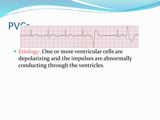 PVCs
 Etiology: One or more ventricular cells are
depolarizing and the impulses are abnormally
conducting through the ventricles.
 
