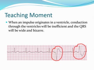 Teaching Moment
 When an impulse originates in a ventricle, conduction
through the ventricles will be inefficient and the QRS
will be wide and bizarre.
 