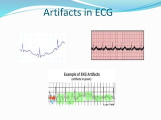 Artifacts in ECG
 