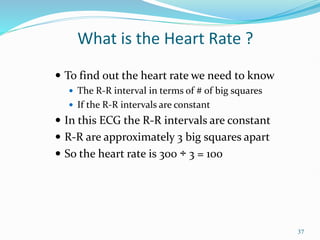 37
 To find out the heart rate we need to know
 The R-R interval in terms of # of big squares
 If the R-R intervals are constant
 In this ECG the R-R intervals are constant
 R-R are approximately 3 big squares apart
 So the heart rate is 300 ÷ 3 = 100
What is the Heart Rate ?
 