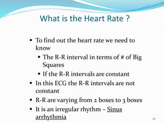 41
 To find out the heart rate we need to
know
 The R-R interval in terms of # of Big
Squares
 If the R-R intervals are constant
 In this ECG the R-R intervals are not
constant
 R-R are varying from 2 boxes to 3 boxes
 It is an irregular rhythm – Sinus
arrhythmia
What is the Heart Rate ?
 