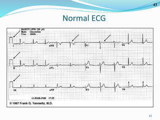 43
43
Normal ECG
 