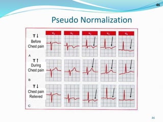 46
46
Pseudo Normalization
Before
Chest pain
During
Chest pain
Chest pain
Relieved
T↓
T↓
T↑
 