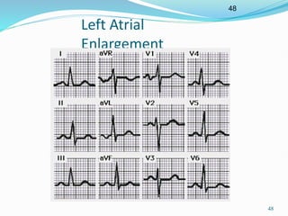 48
48
Left Atrial
Enlargement
 