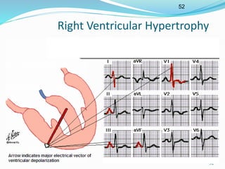 52
52
Right Ventricular Hypertrophy
 