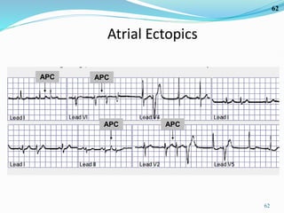 62
62
Atrial Ectopics
APC
APC
APC
APC
 