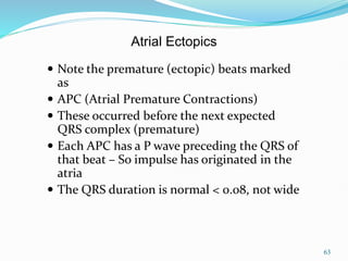 63
 Note the premature (ectopic) beats marked
as
 APC (Atrial Premature Contractions)
 These occurred before the next expected
QRS complex (premature)
 Each APC has a P wave preceding the QRS of
that beat – So impulse has originated in the
atria
 The QRS duration is normal < 0.08, not wide
Atrial Ectopics
 