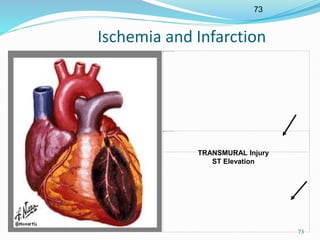 73
73
Ischemia and Infarction
TRANSMURAL Injury
ST Elevation
 