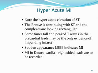 84
Hyper Acute MI
 Note the hyper acute elevation of ST
 The R wave is continuing with ST and the
complexes are looking rectangular
 Some times tall and peaked T waves in the
precardial leads may be the only evidence of
impending infarct
 Sudden appearance LBBB indicates MI
 MI in Dextro-cardia – right sided leads are to
be recorded
 