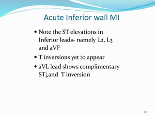 86
 Note the ST elevations in
Inferior leads- namely L2, L3
and aVF
 T inversions yet to appear
 aVL lead shows complimentary
ST↓and T inversion
Acute Inferior wall MI
 