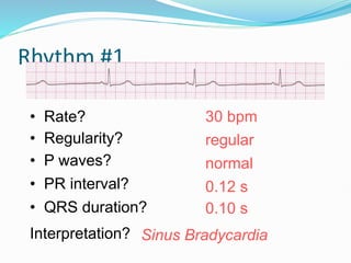 Rhythm #1
30 bpm
• Rate?
• Regularity? regular
normal
0.10 s
• P waves?
• PR interval? 0.12 s
• QRS duration?
Interpretation? Sinus Bradycardia
 