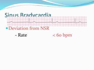Sinus Bradycardia
Deviation from NSR
- Rate < 60 bpm
 