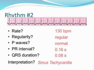 Rhythm #2
130 bpm
• Rate?
• Regularity? regular
normal
0.08 s
• P waves?
• PR interval? 0.16 s
• QRS duration?
Interpretation? Sinus Tachycardia
 