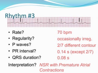 Rhythm #3
70 bpm
• Rate?
• Regularity? occasionally irreg.
2/7 different contour
0.08 s
• P waves?
• PR interval? 0.14 s (except 2/7)
• QRS duration?
Interpretation? NSR with Premature Atrial
Contractions
 