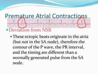 Premature Atrial Contractions
Deviation from NSR
 These ectopic beats originate in the atria
(but not in the SA node), therefore the
contour of the P wave, the PR interval,
and the timing are different than a
normally generated pulse from the SA
node.
 