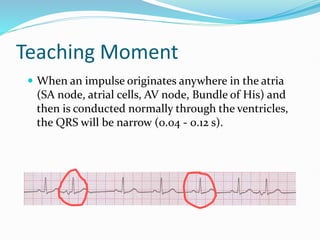 Teaching Moment
 When an impulse originates anywhere in the atria
(SA node, atrial cells, AV node, Bundle of His) and
then is conducted normally through the ventricles,
the QRS will be narrow (0.04 - 0.12 s).
 