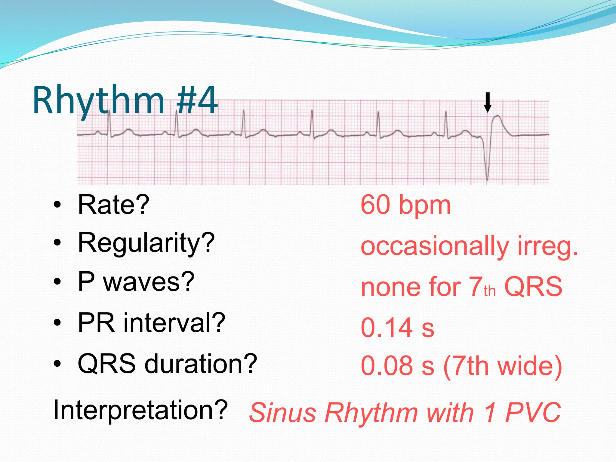 Rhythm #4
60 bpm
• Rate?
• Regularity? occasionally irreg.
none for 7th QRS
0.08 s (7th wide)
• P waves?
• PR interval? 0.14 s
• QRS duration?
Interpretation? Sinus Rhythm with 1 PVC
 