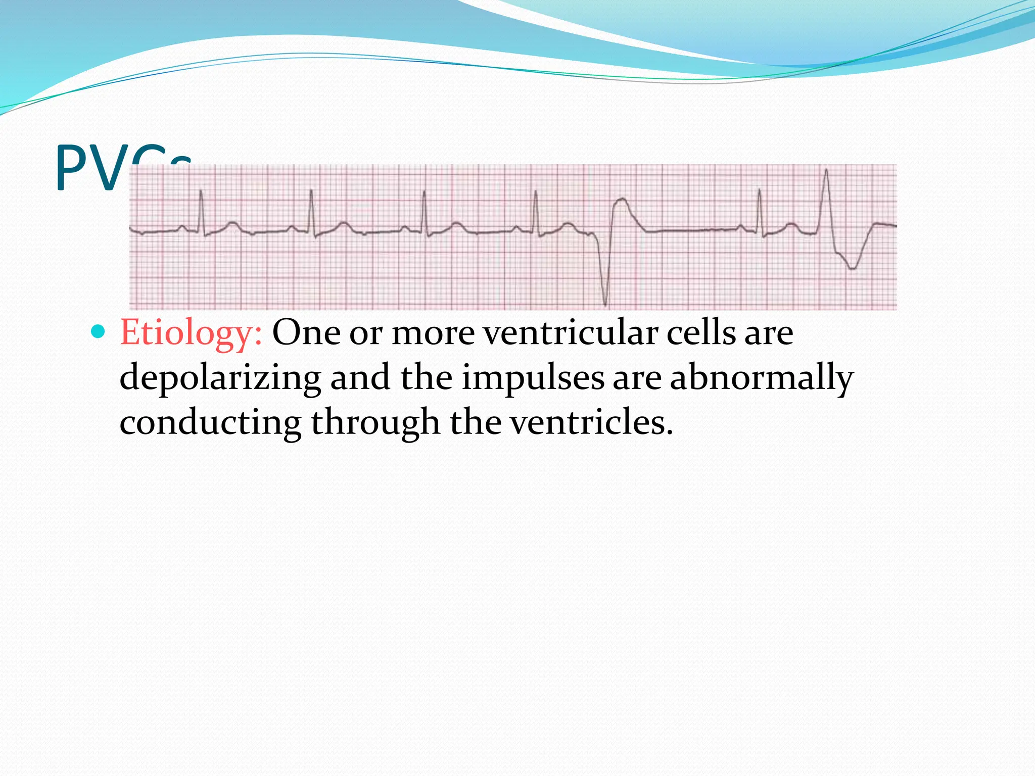 PVCs
 Etiology: One or more ventricular cells are
depolarizing and the impulses are abnormally
conducting through the ventricles.
 