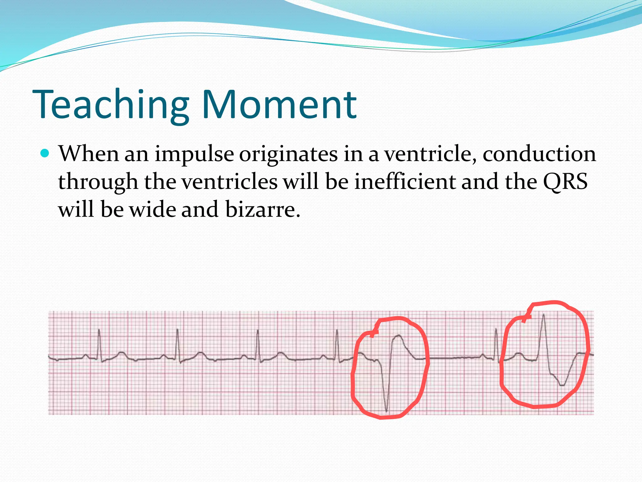 Teaching Moment
 When an impulse originates in a ventricle, conduction
through the ventricles will be inefficient and the QRS
will be wide and bizarre.
 