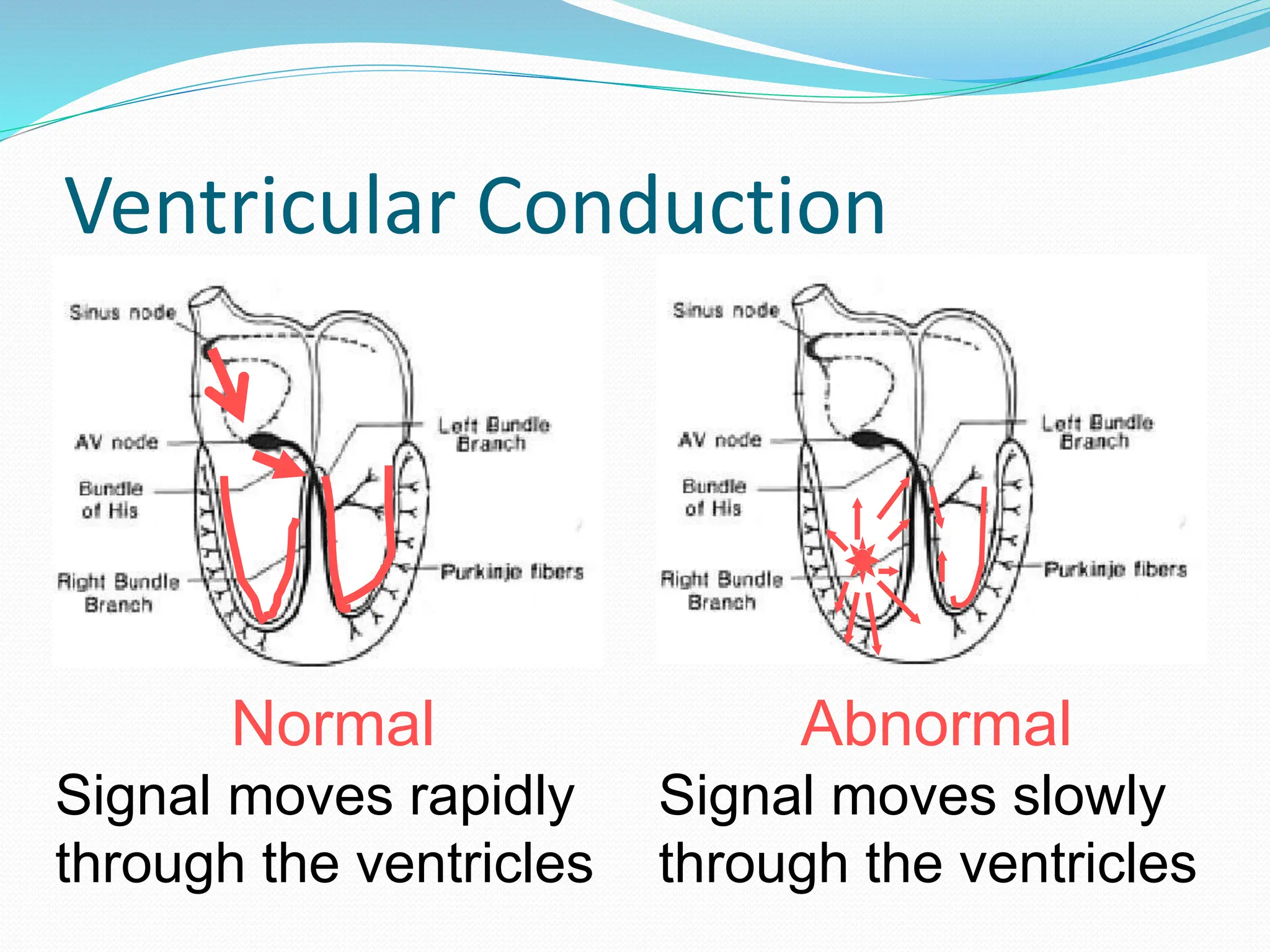 Ventricular Conduction
Normal
Signal moves rapidly
through the ventricles
Abnormal
Signal moves slowly
through the ventricles
 