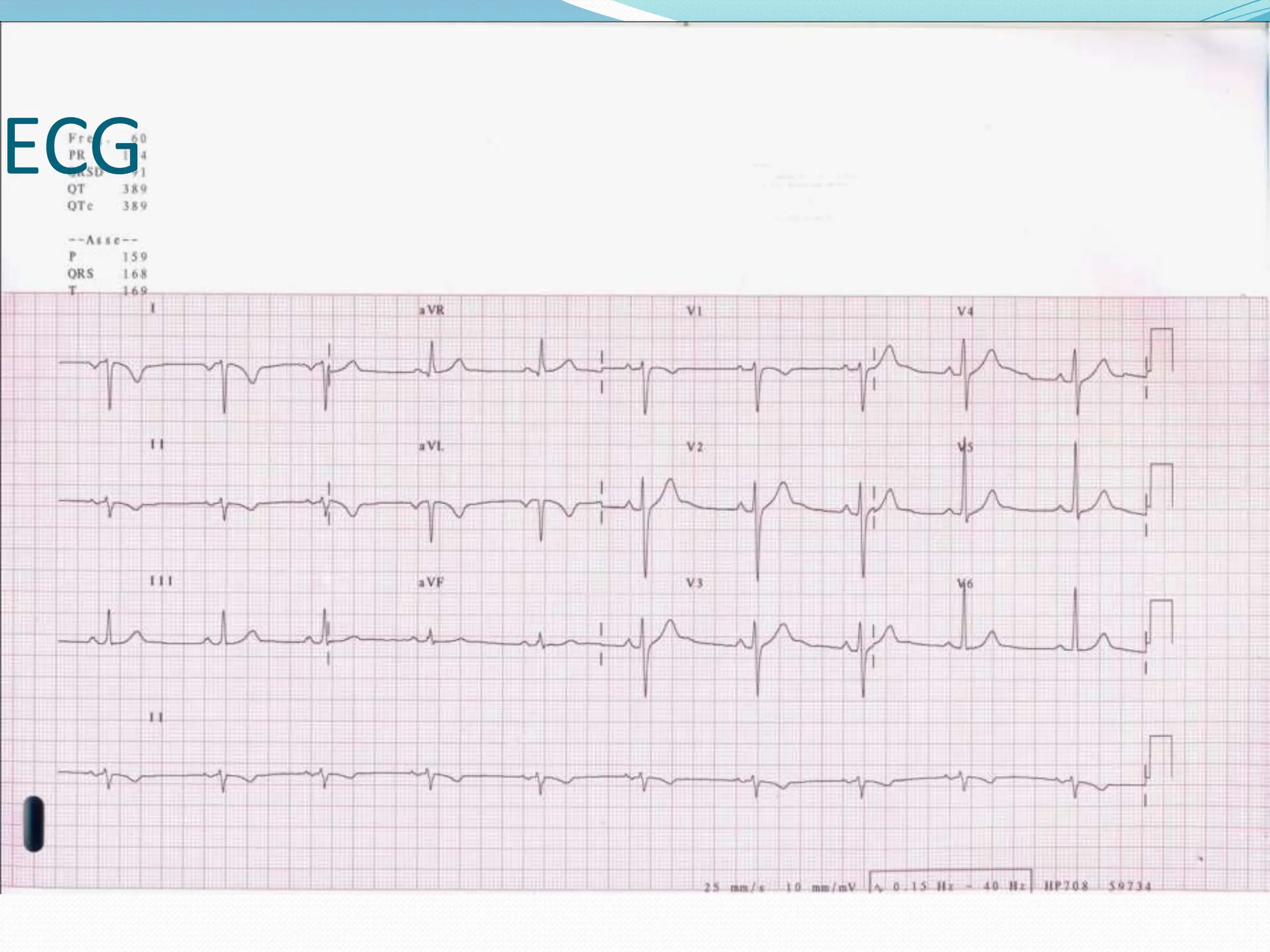 ECG
 
