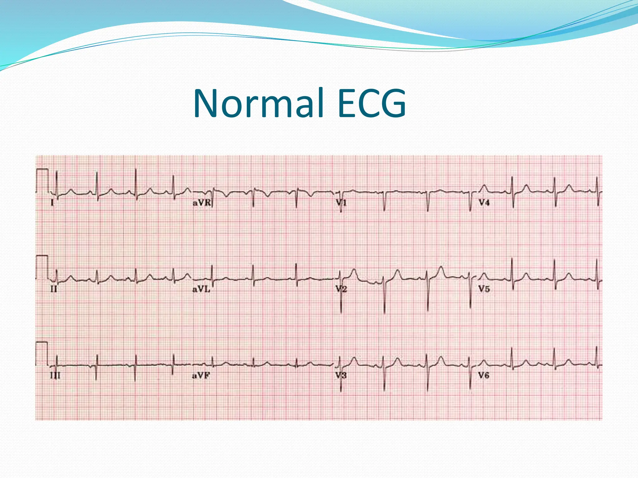 Normal ECG
 