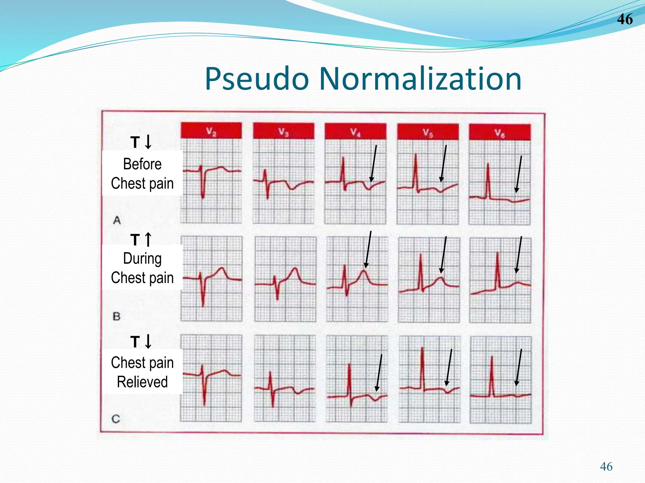 46
46
Pseudo Normalization
Before
Chest pain
During
Chest pain
Chest pain
Relieved
T↓
T↓
T↑
 